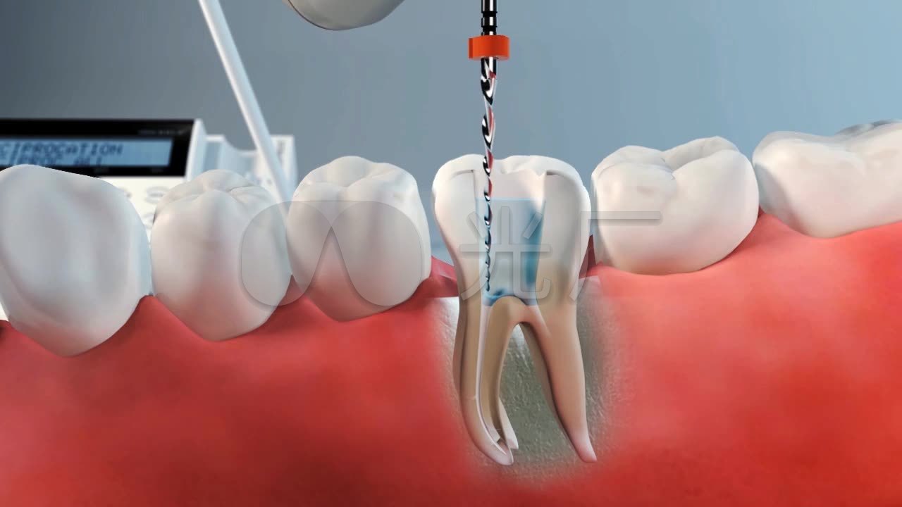 牙齿健康修护医疗三维模拟动画演示_1280x720_高清(:)