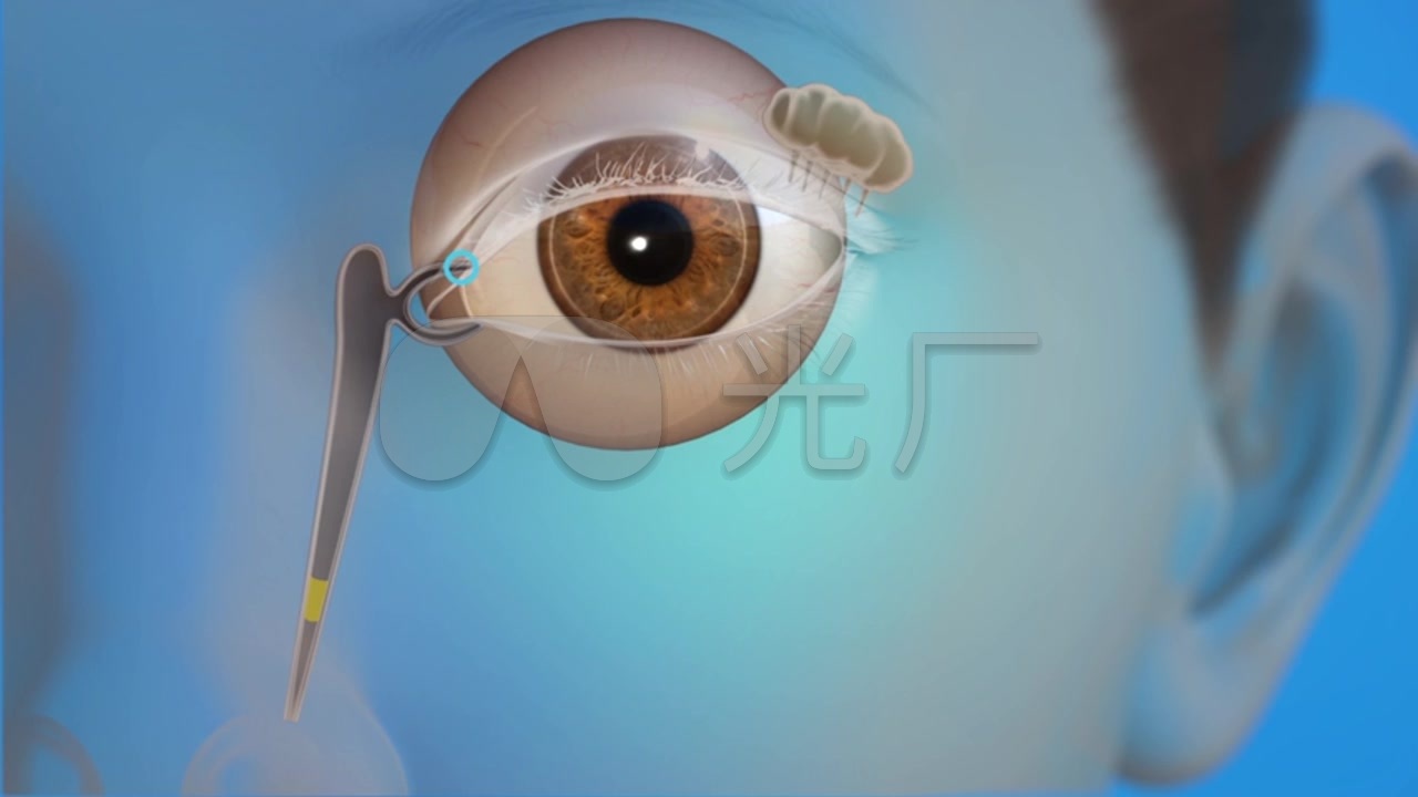 3d医学小儿鼻泪管阻塞实际情况