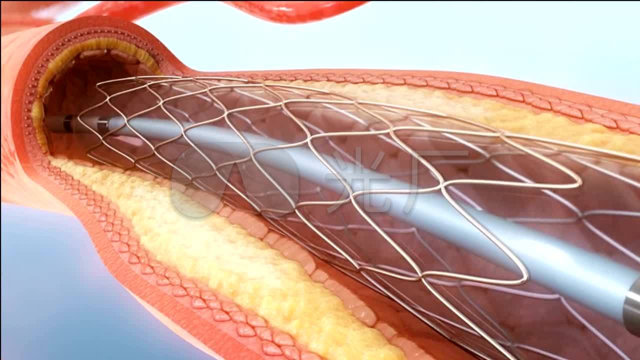 血管搭桥支架手术科技人体心脏_1280X720_高