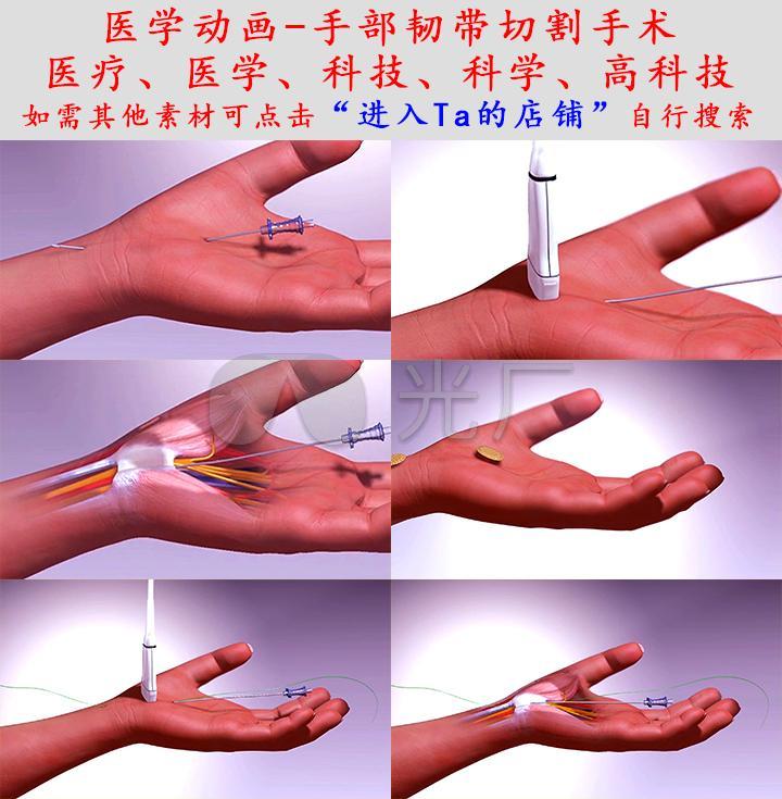 医学动画-手部韧带切割手术