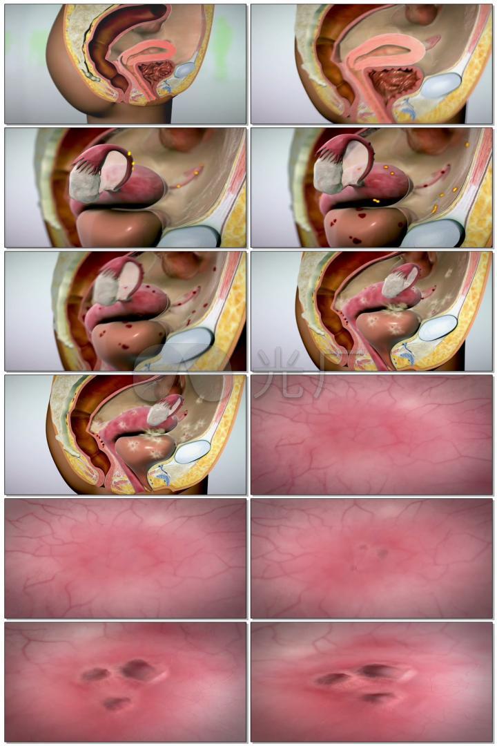 子宫内膜异位症治疗医疗三维机理动画