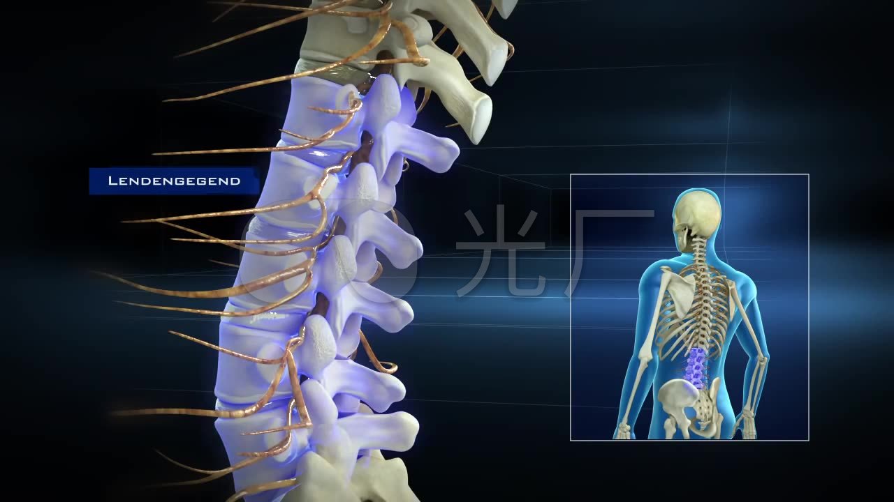 3d医疗人体腰椎骨骨质增生挤压神经手术修
