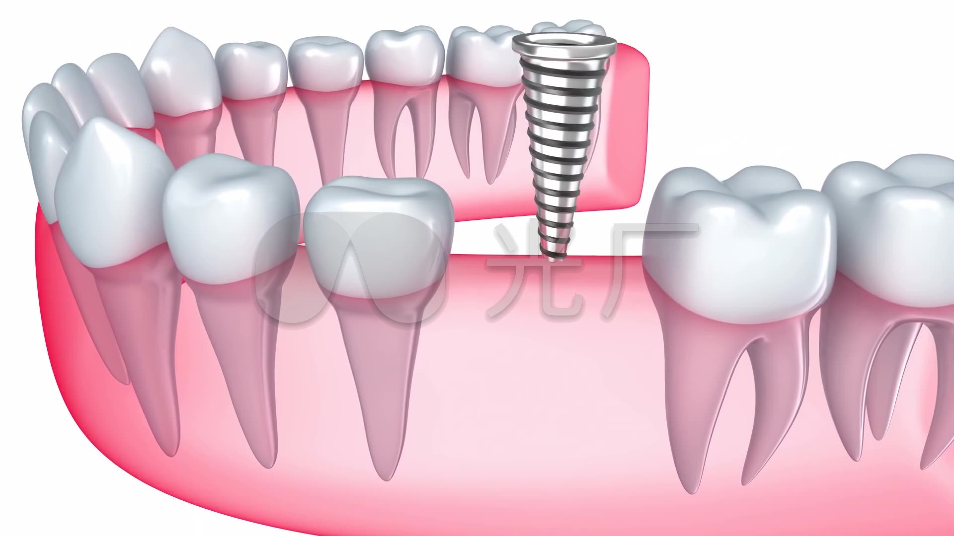 种植牙三维动画_1920x1080_高清视频素材下载(编号:)
