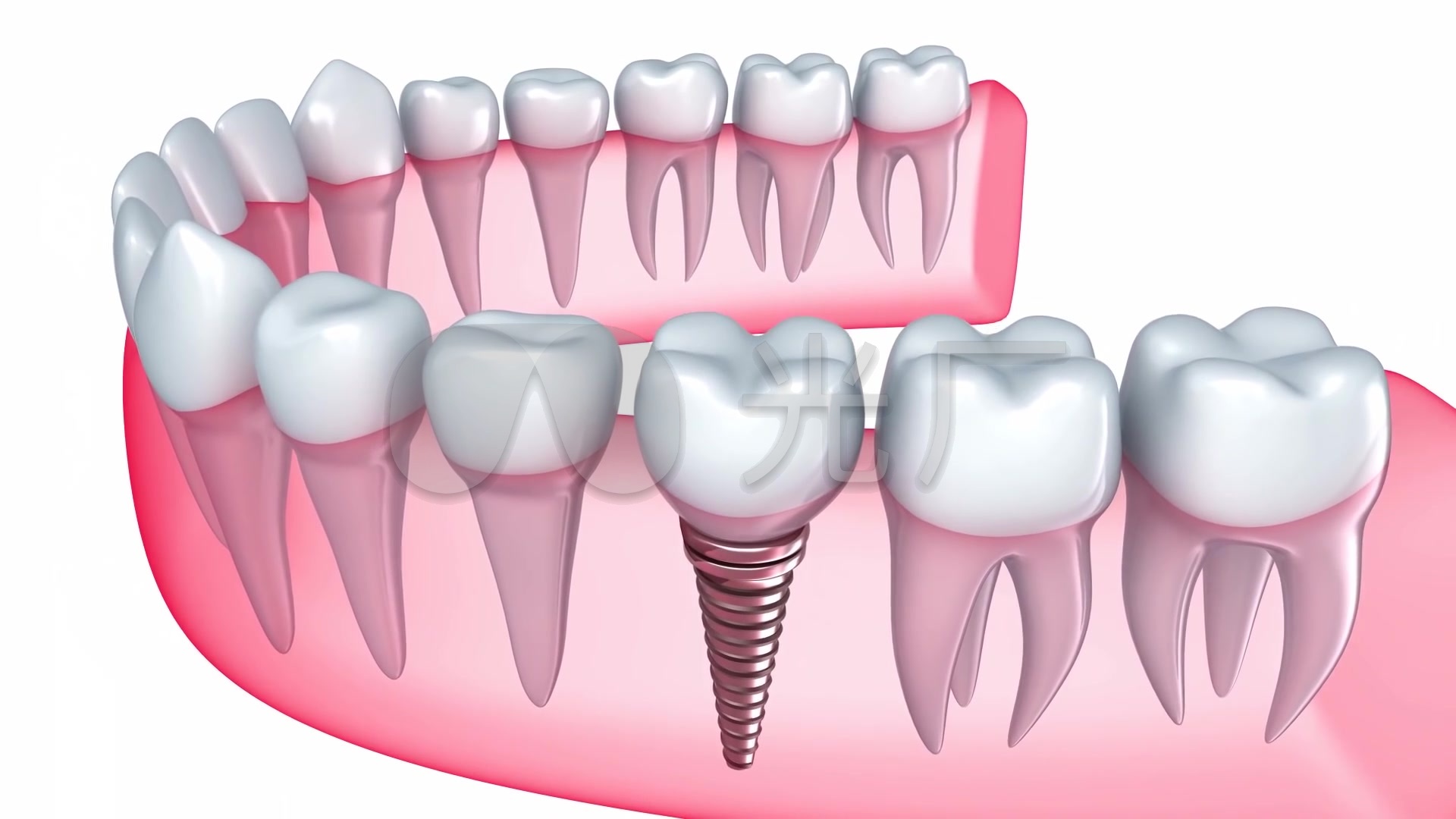 种植牙三维动画_1920x1080_高清视频素材下载(编号:)