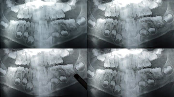 x光拍x片牙医牙齿疾病