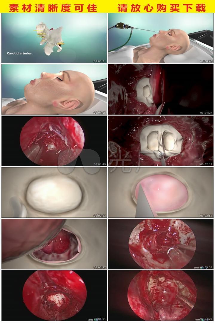 3d医疗脑科脑下垂垂体瘤内镜切除手术动画