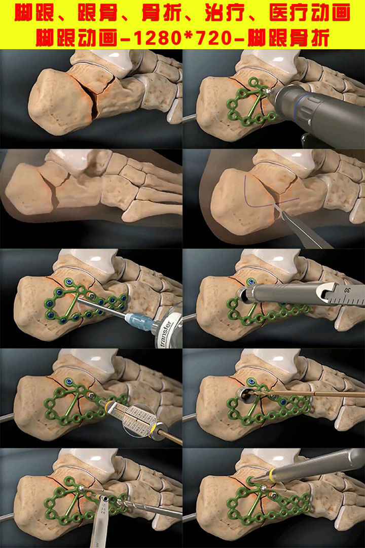 脚跟跟骨骨折治疗医疗动画