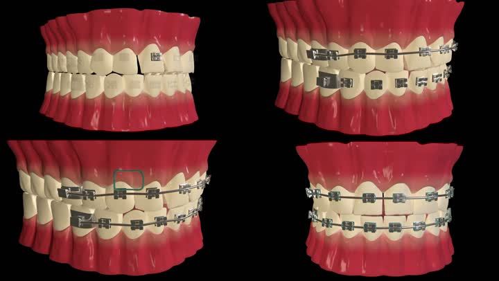牙齿牙龈装牙套牙齿矫正医学医疗牙齿整形演示动画三维动画模拟