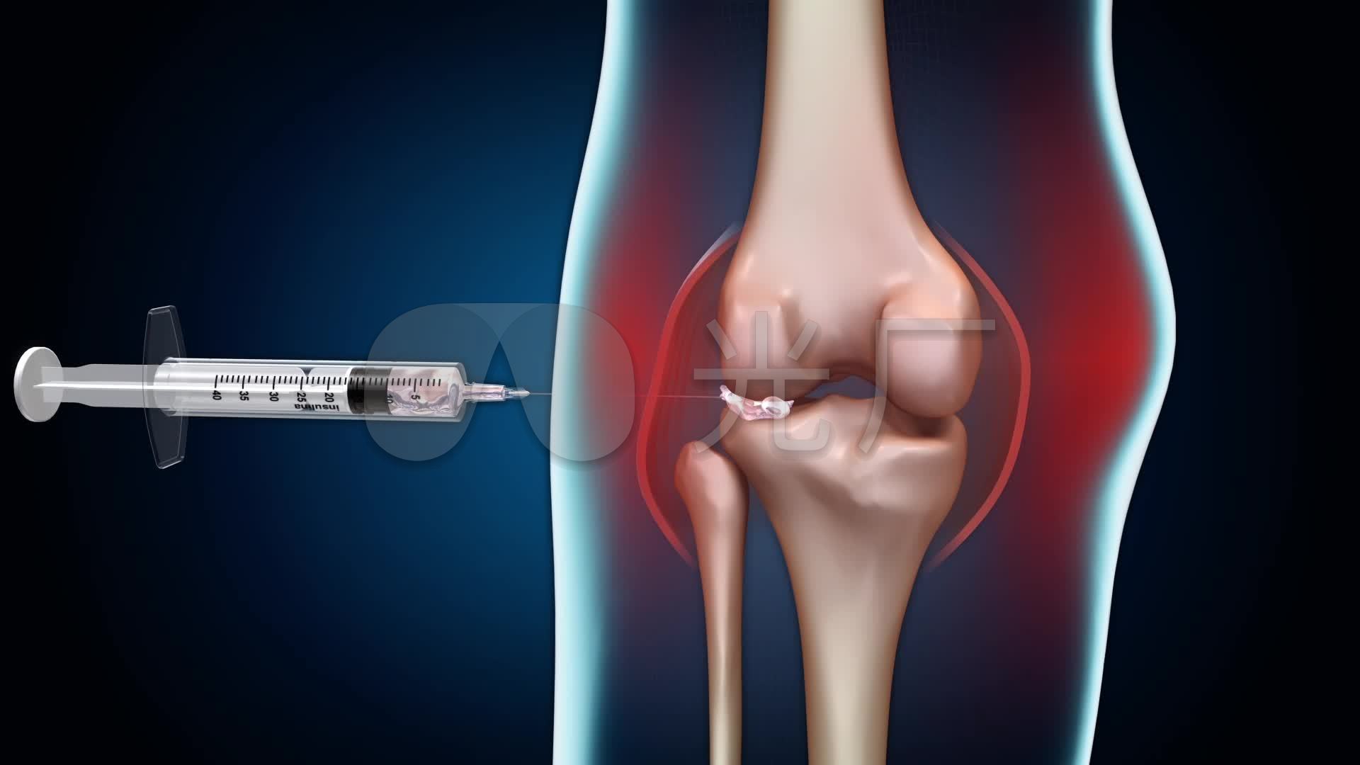 透明质酸钠几丁糖注射进关节腔治疗骨关节炎
