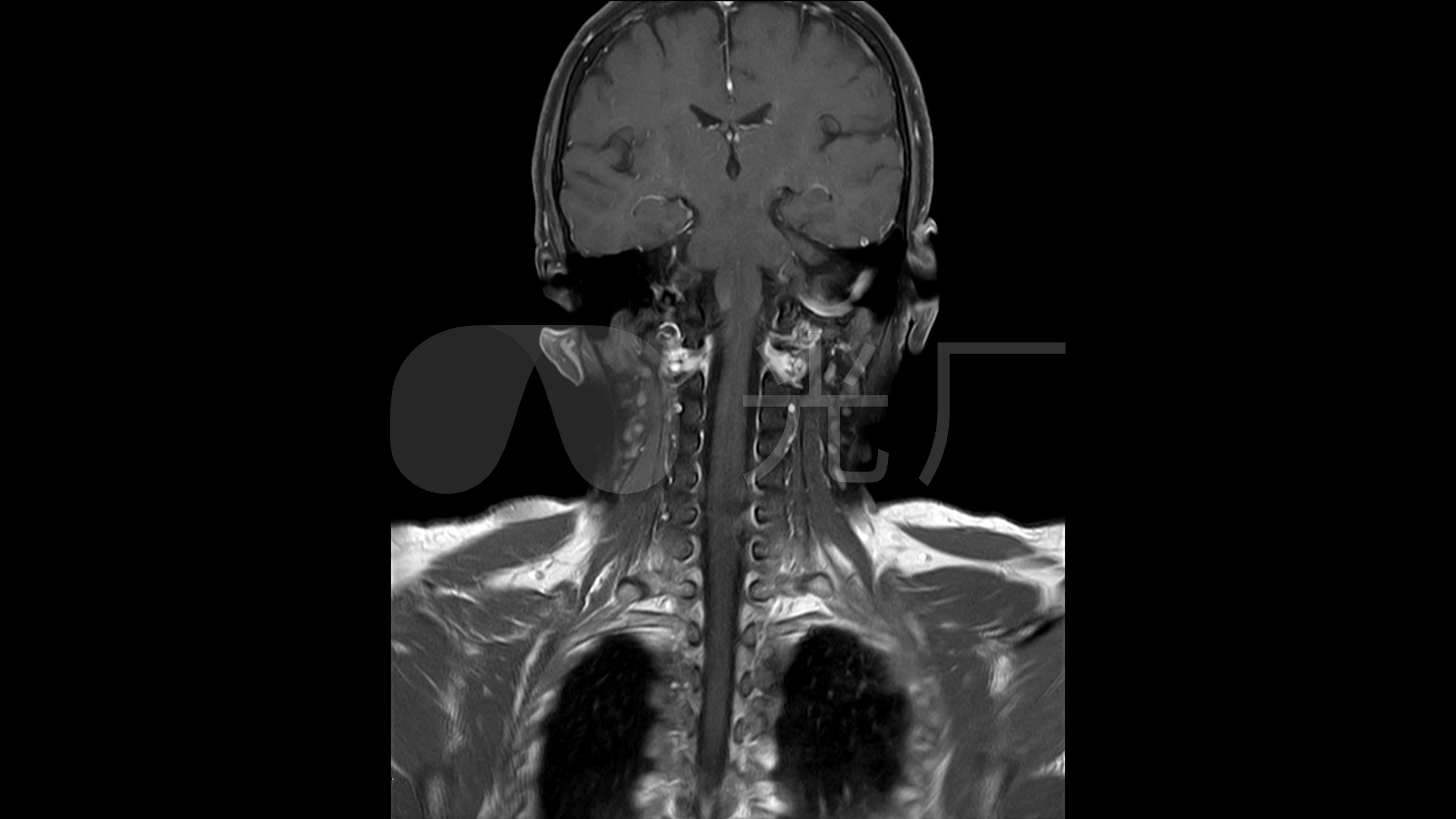 颈部核磁共振成像_3840x2160_高清视频素材下载(编号