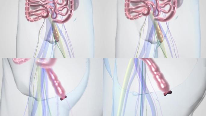 三维动画模拟痔疮切除