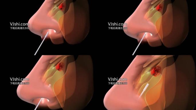 鼻内窥镜可见病变