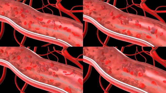 形成大小不一斑块、血栓，粥样硬化，黏在血