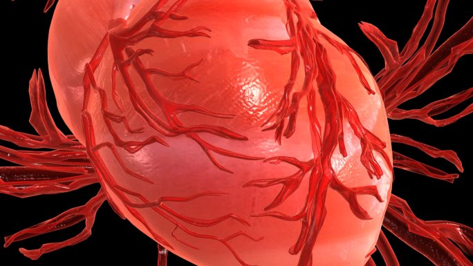 堵在心血管上，就产生冠心病乃至心梗