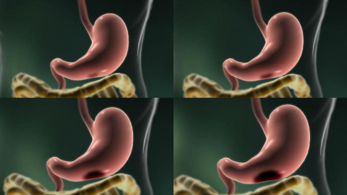 胃溃疡动画演示