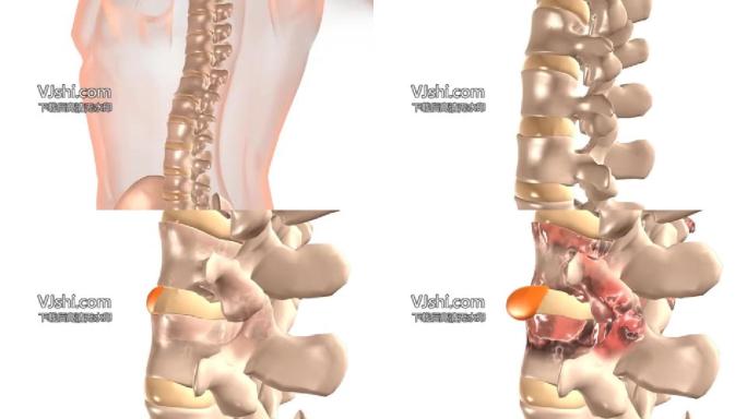 病因腰椎间盘改变病变