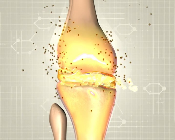 医学医疗医学类骨关节积液