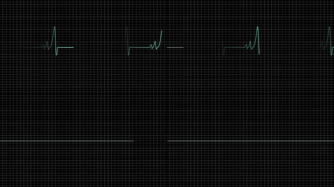 心电图跳到停止