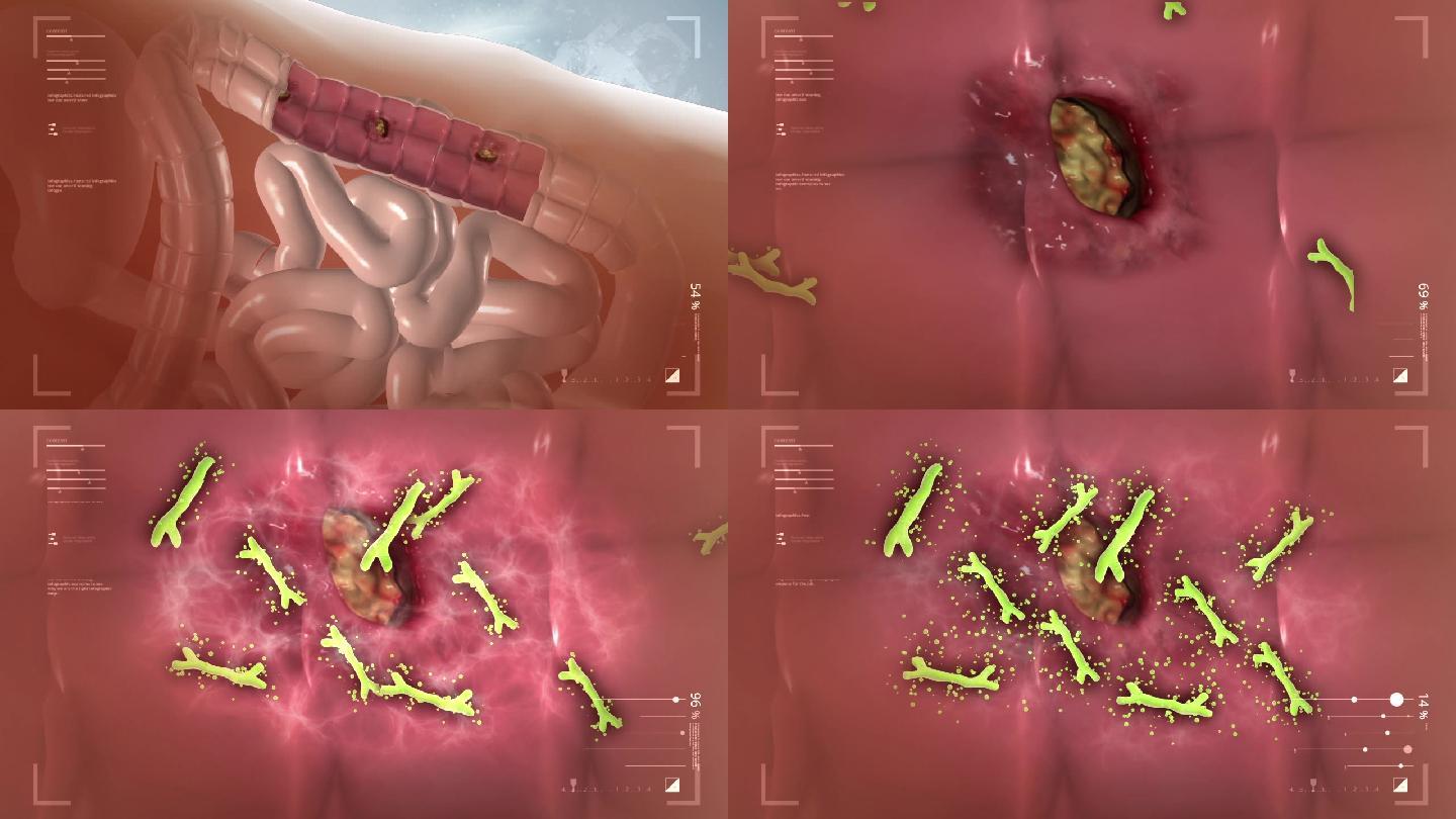 肠道出现溃疡修复溃疡