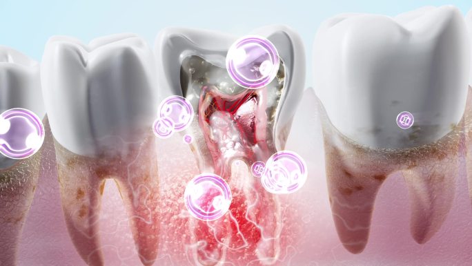 修复牙根炎症