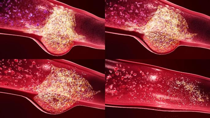 清除血管粥样斑块