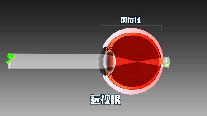 正常和近视眼远视眼眼球视力调整原理动画