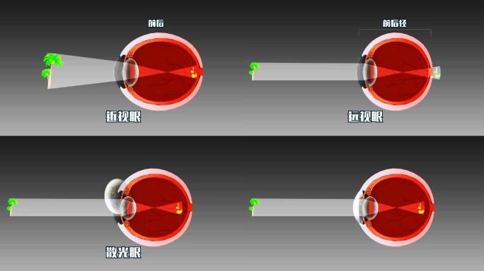 正常和近视眼远视眼眼球视力调整原理动画