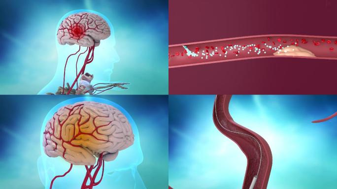 大脑人体脑梗塞病因治疗三维人体动画