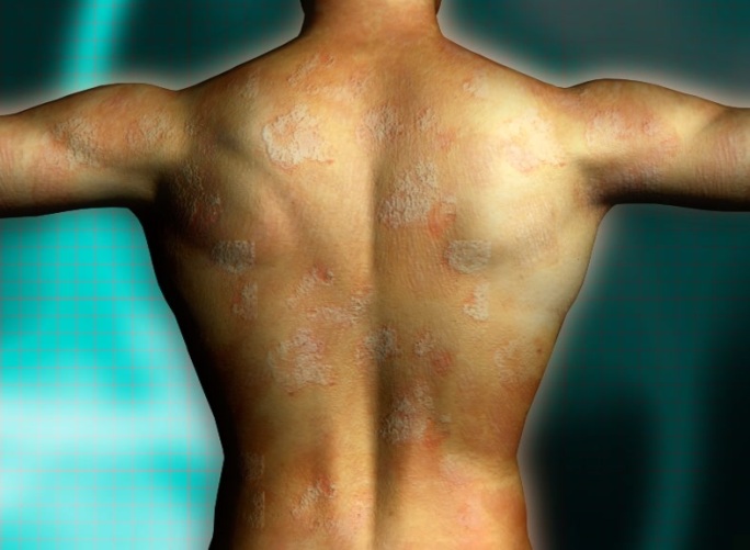 人体治愈皮肤皮肤病伤口细菌细
