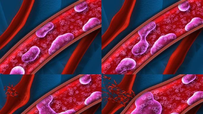 血管血管堵塞血管破裂病变细胞