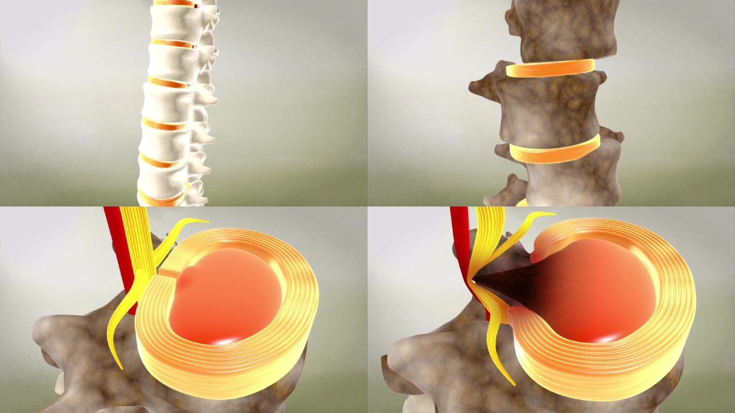 腰间盘突出腰椎病变
