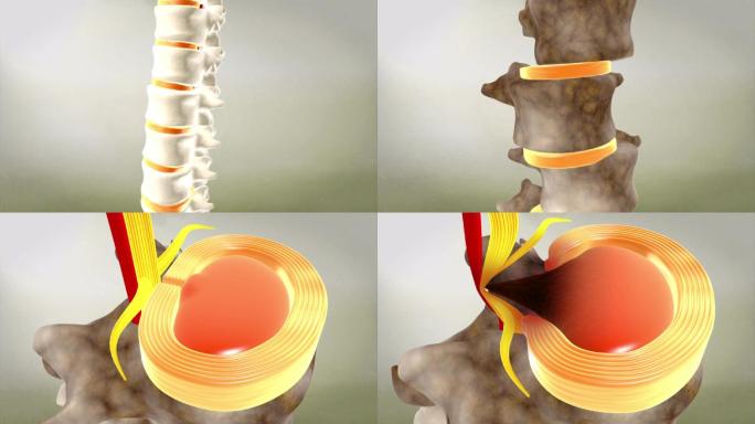 腰间盘突出腰椎病变