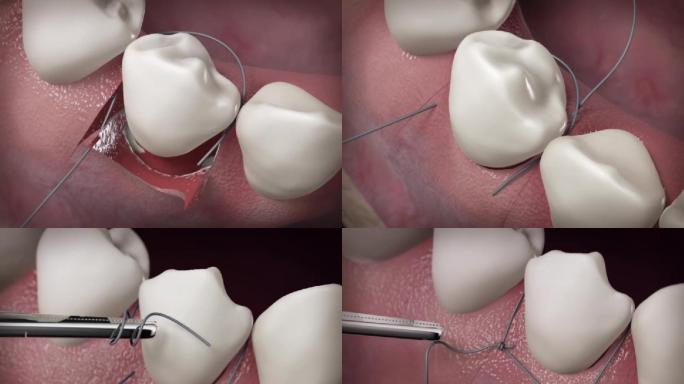 【三维】口腔口腔牙齿缝合手术口腔动画三维