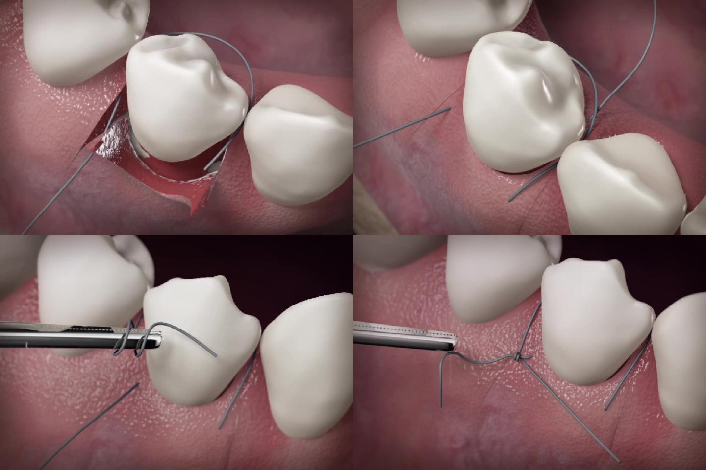 【三维】口腔口腔牙齿缝合手术口腔动画三维