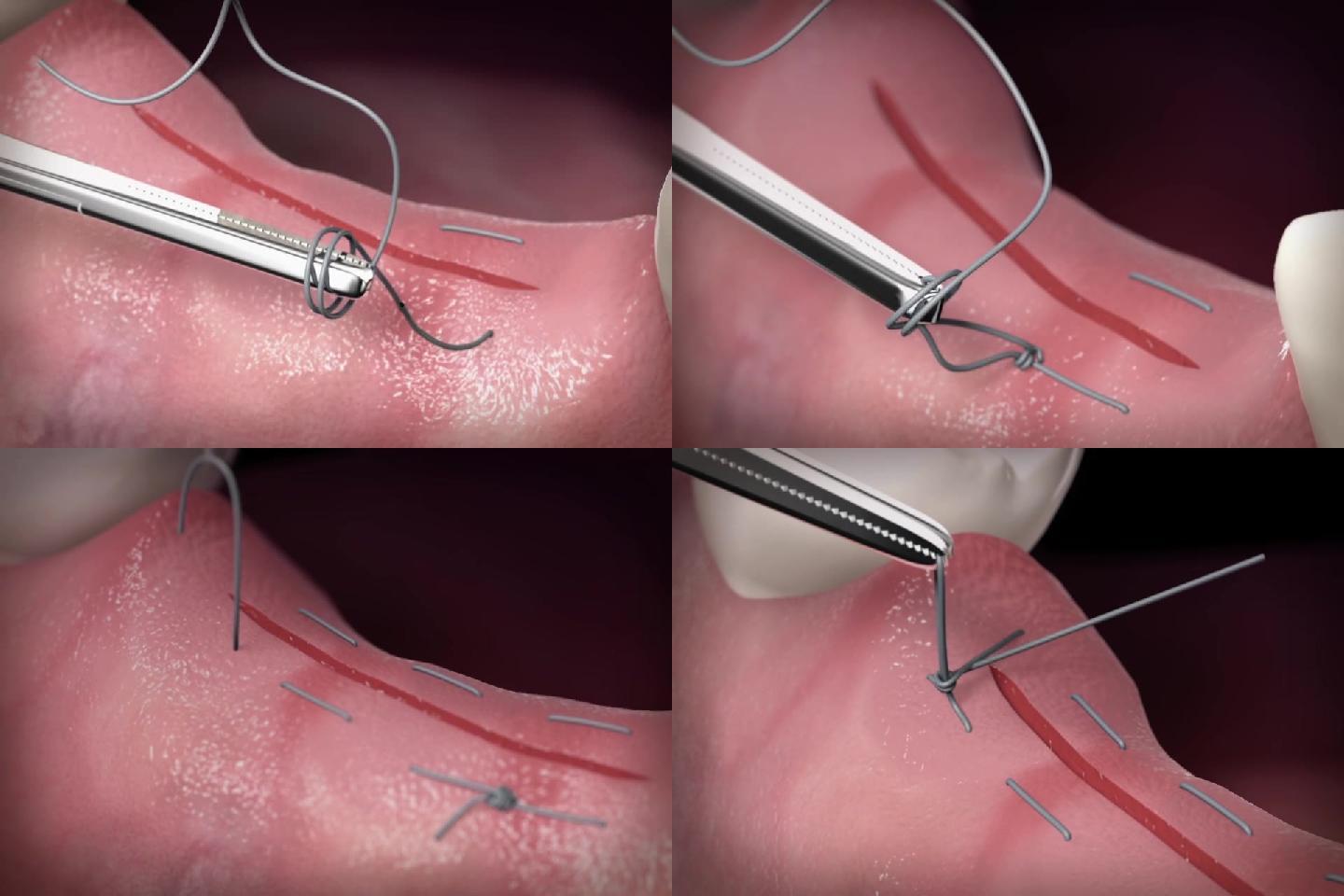 【三维】口腔牙齿缝合手术口腔动画三维动画