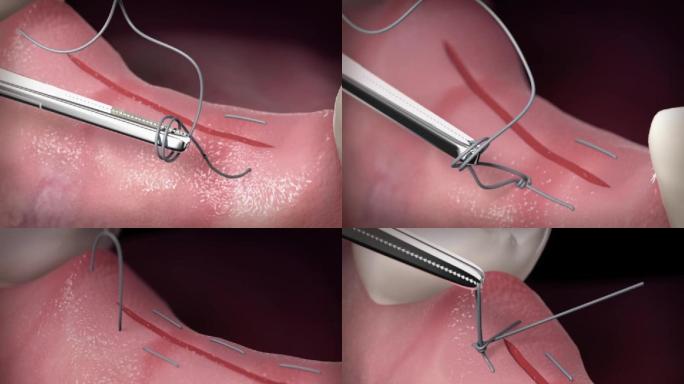 【三维】口腔牙齿缝合手术口腔动画三维动画