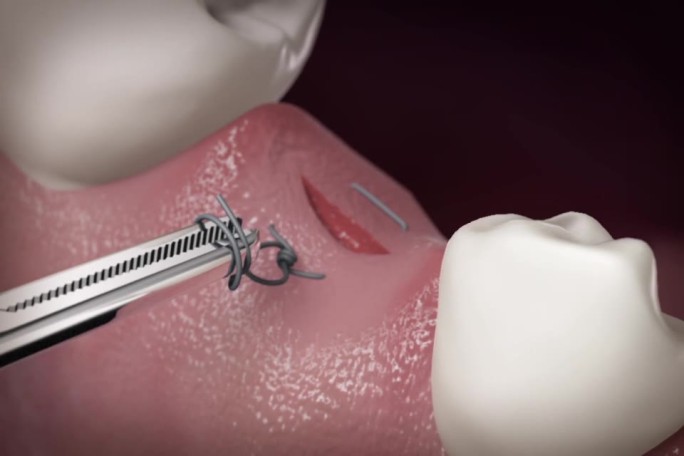 【三维】牙齿口腔牙龈缝合手术三维牙齿