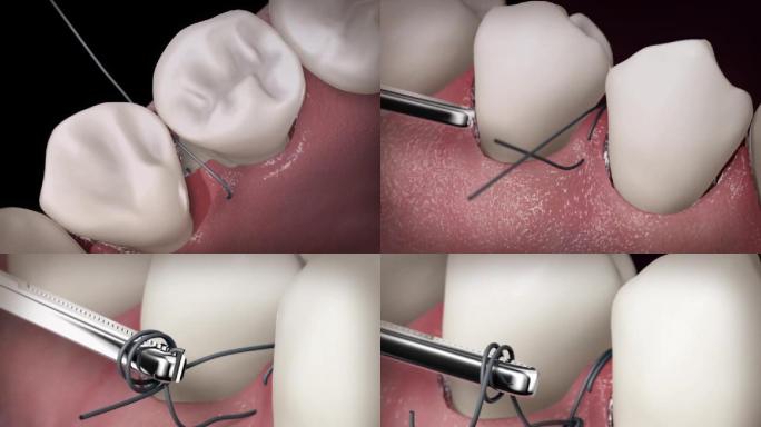 【三维】牙齿口腔缝合手术牙龈缝合手术