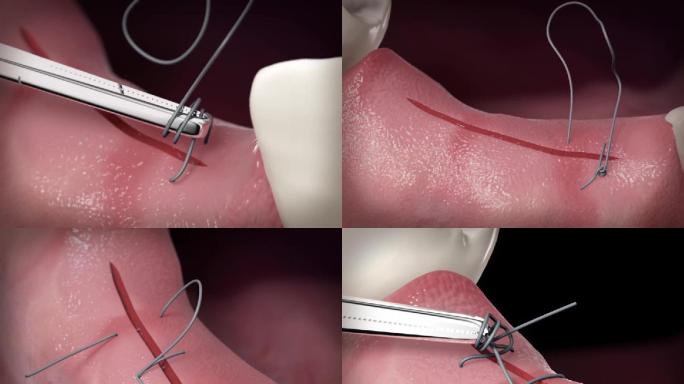 【三维】口腔牙齿缝合手术口腔动画三维
