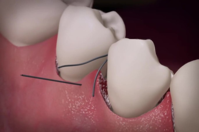 【三维】口腔牙齿缝合手术口腔动画三维口腔