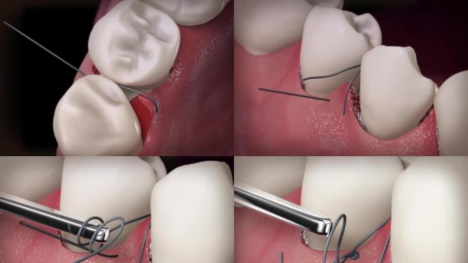 【三维】口腔牙齿缝合手术口腔动画三维口腔