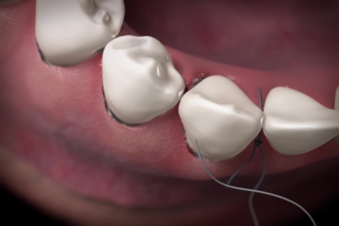【三维】牙齿口腔牙龈缝合手术三维牙齿口腔