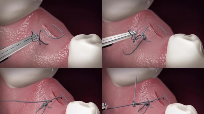 【三维】口腔牙齿缝合手术口腔动画三维