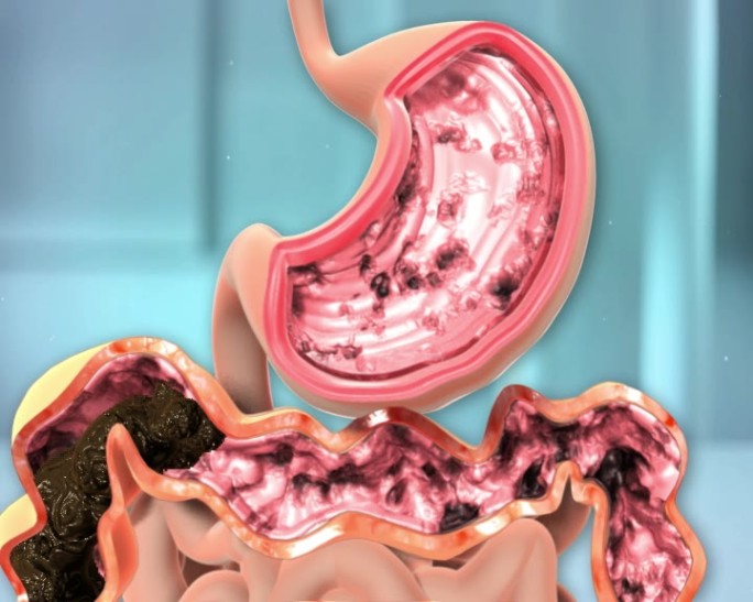 肠胃疾病产生与治疗