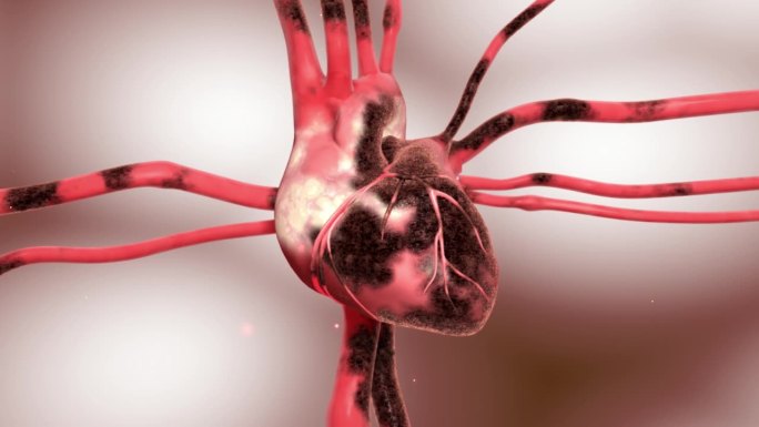 心脏病心梗三维素材