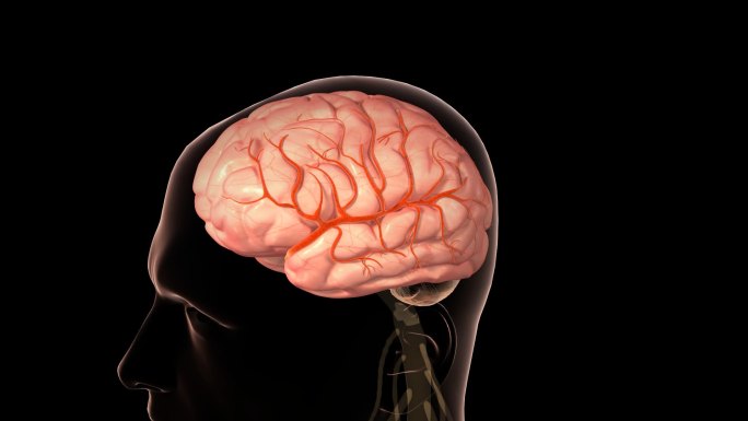【原创】脑卒中大脑血管堵塞-序列