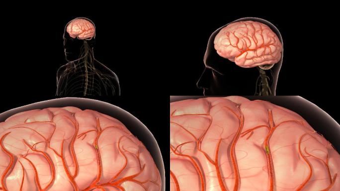 【原创】脑卒中大脑血管堵塞-序列