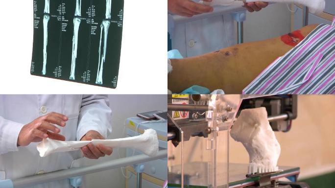 医院医疗X光人体骨骼骨折3d打印技术科技