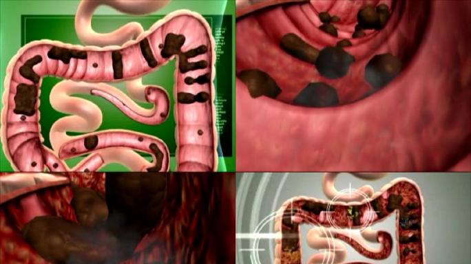 肠道清理垃圾