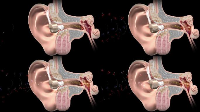 助听器作用机理素材